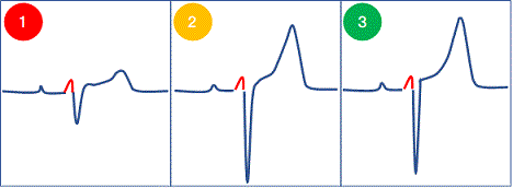 不良 高 r は 波 増 と 心電図検査のＲ波増高不良って何ですか？